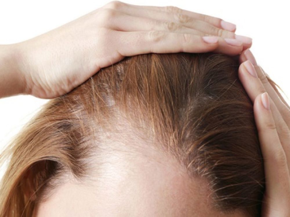 Chá de cebola pode tratar a sua alopecia