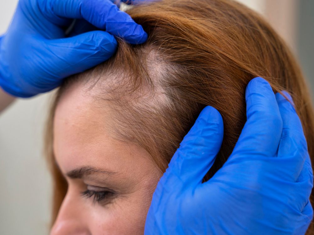 O que queda de cabelo pode significar? Doença Genética. 